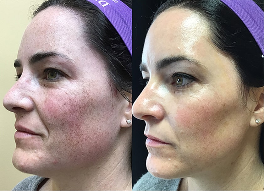 Before and After results of a Dermtology Associates Patient