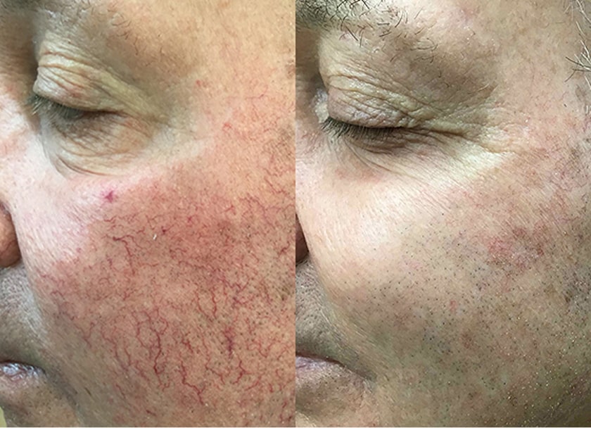 Before and After results of a Dermtology Associates Patient
