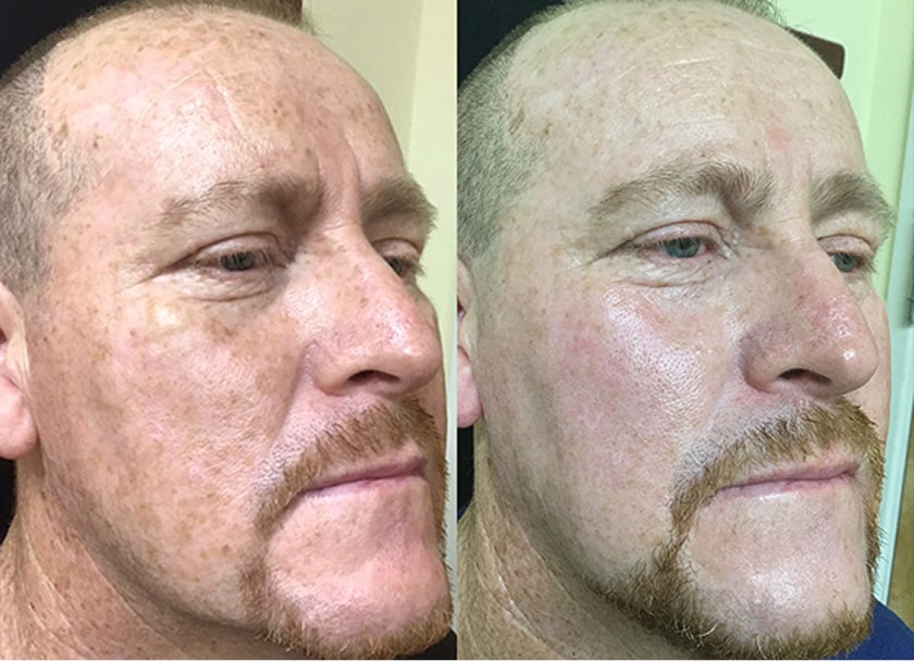 Before and After results of a Dermtology Associates Patient