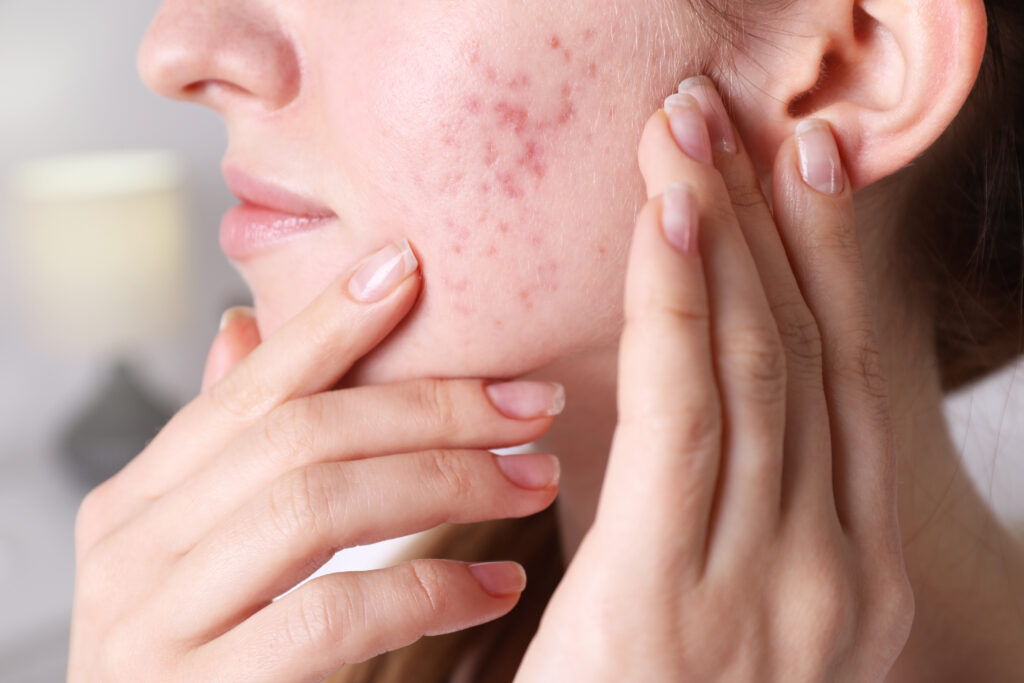 Strong Acne on a Female Cheek