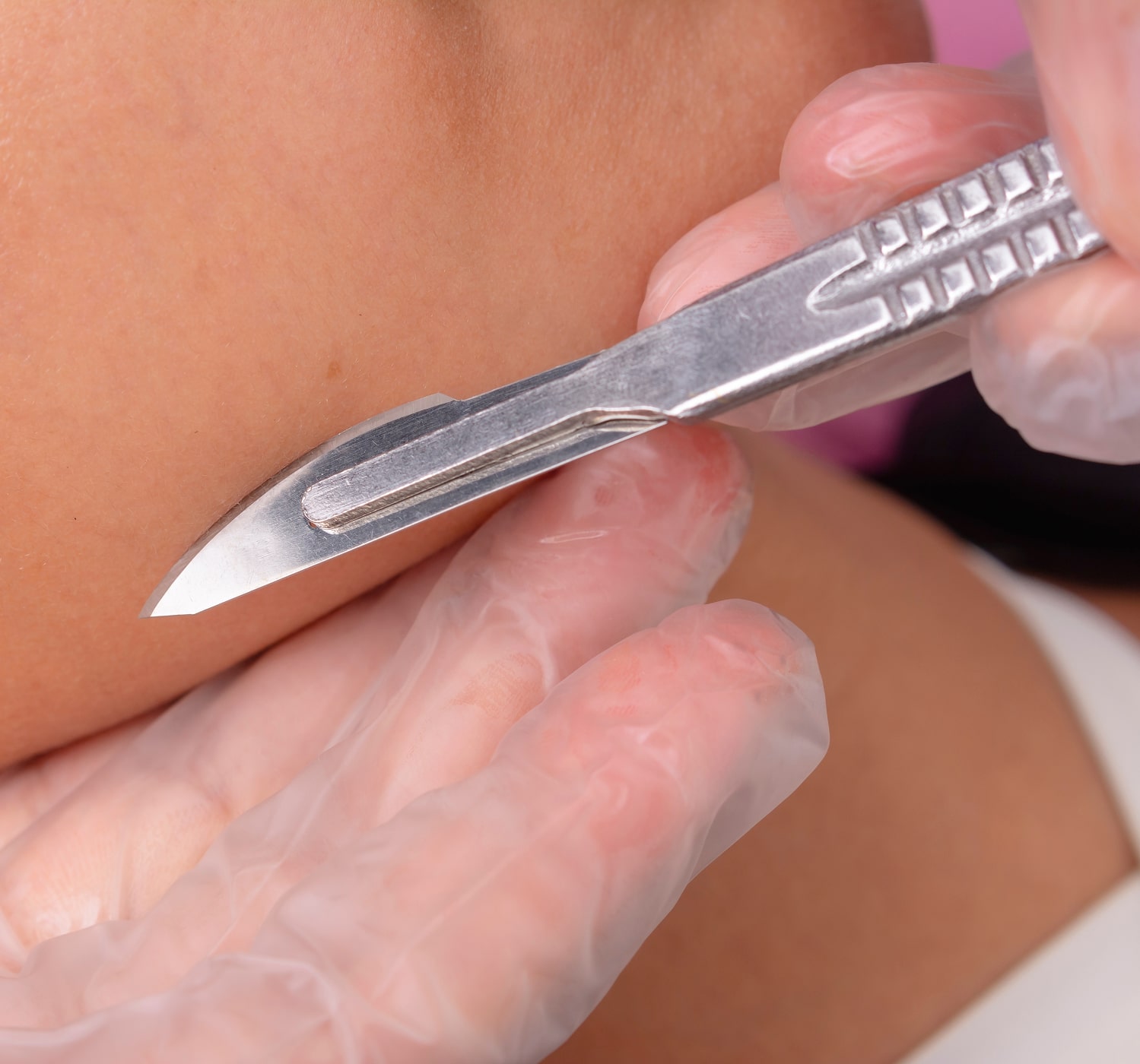 Dermaplaning Procedure Close Up Image