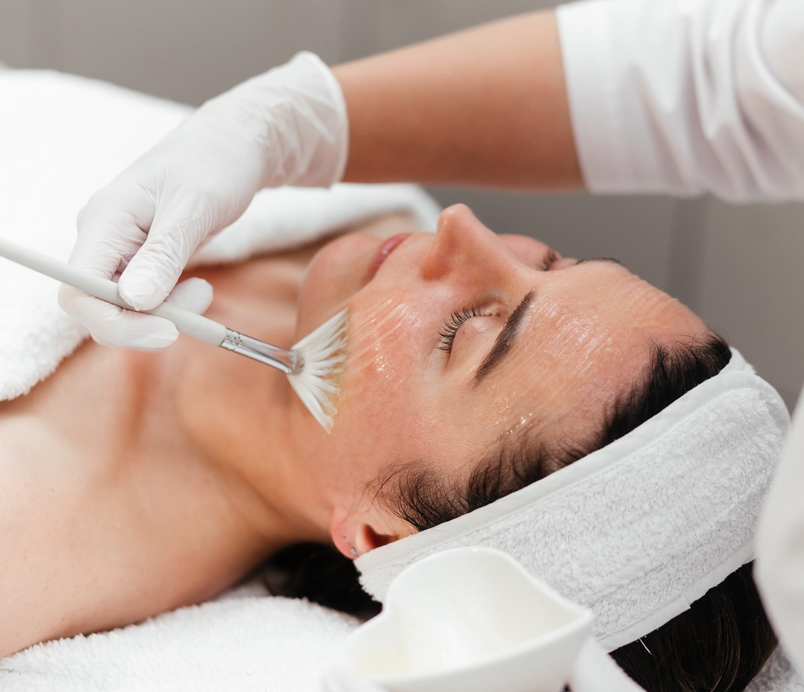 Chemical Peel Treatment with a Female Stock Model