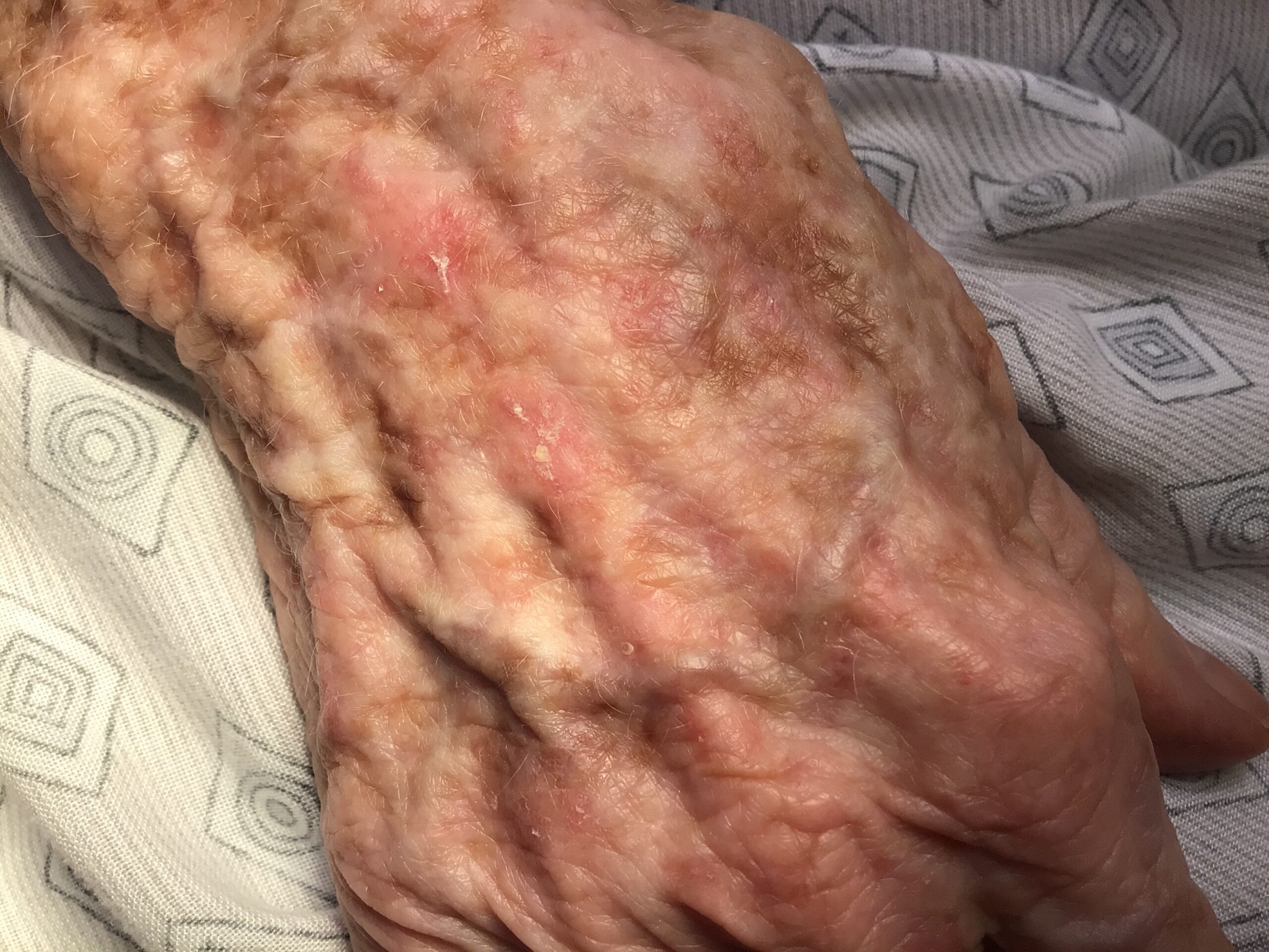 Actinic Keratoses on patient's hand