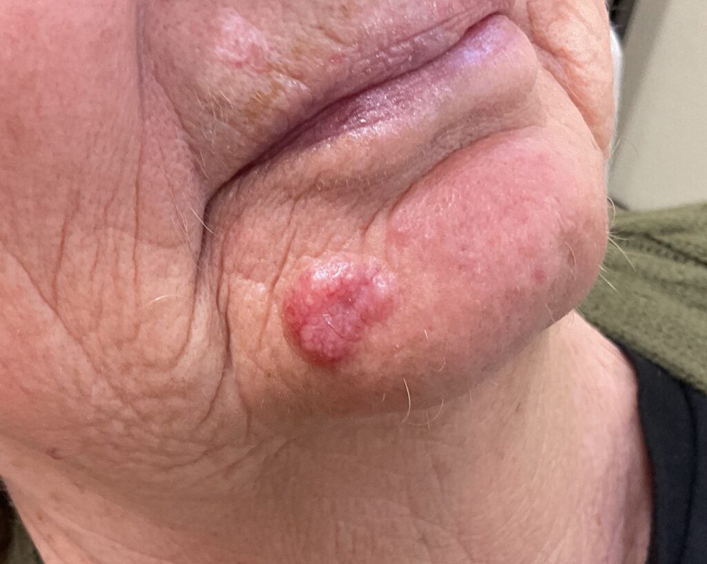 Close up of basal cell carcinoma on chin during a consultation at Dermatology Associates of the Bay Area