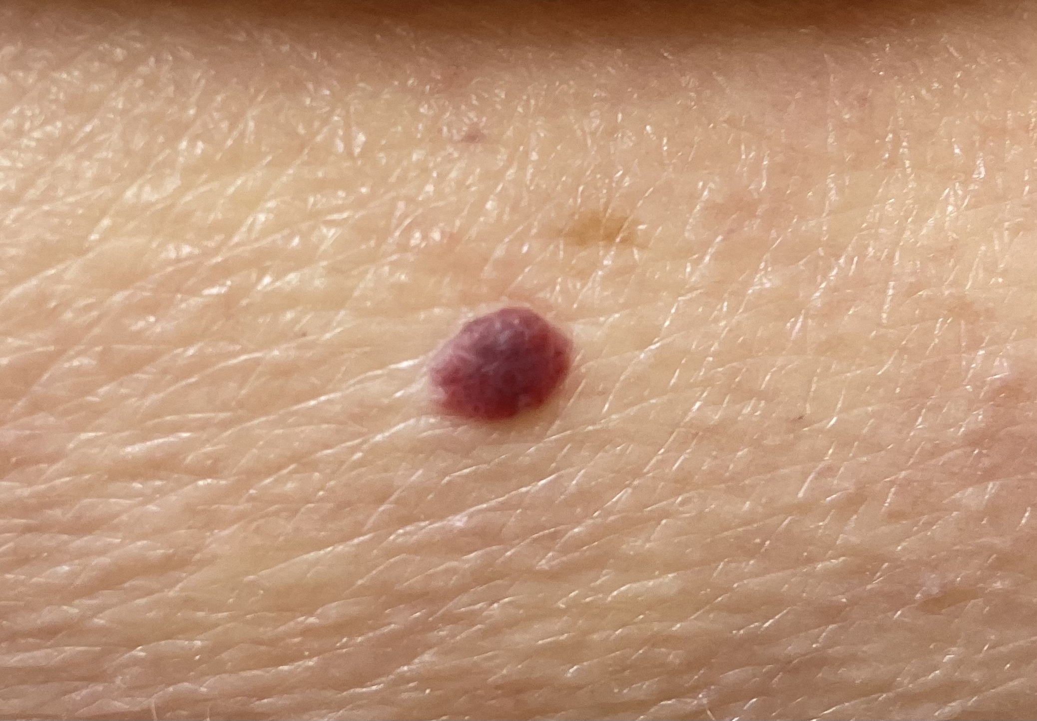Cherry Angioma