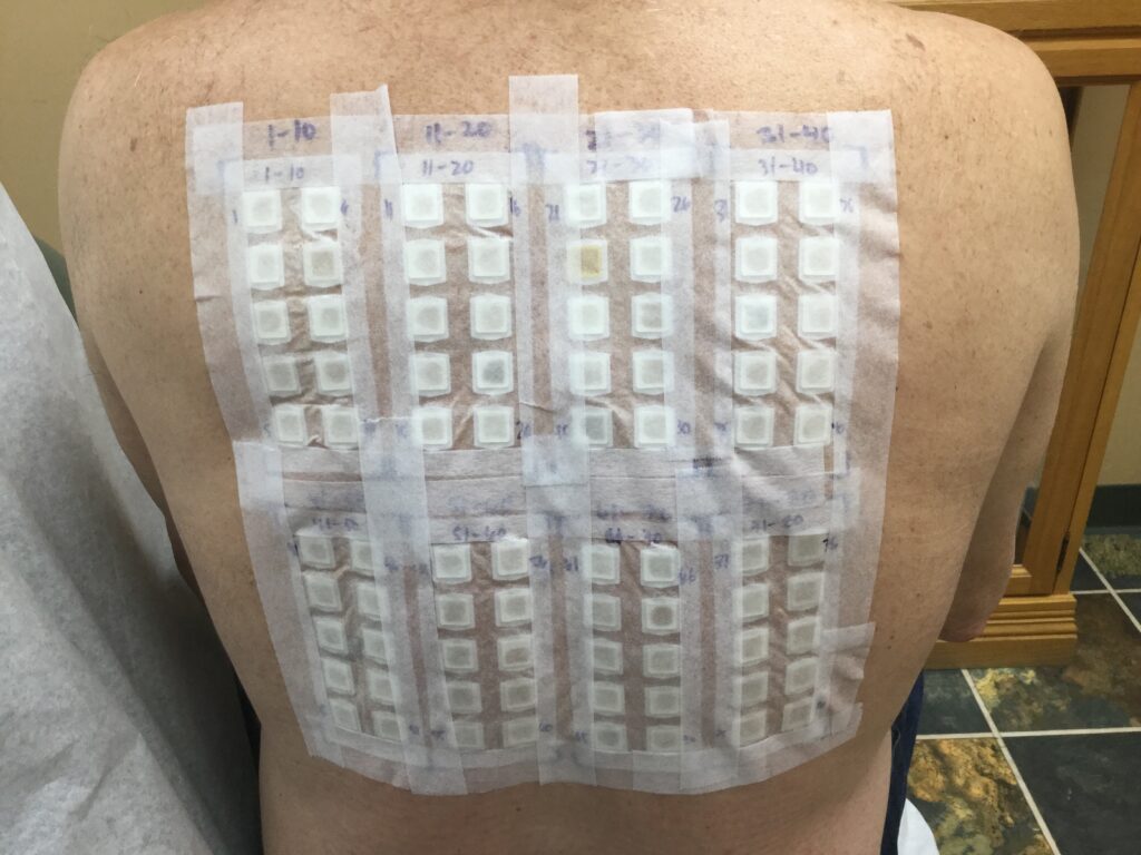 patch testing for allergic contact dermatitis