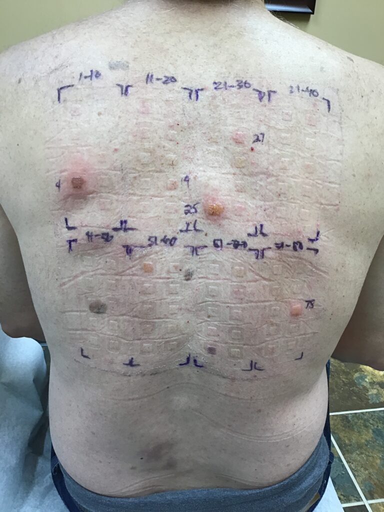 allergic contact dermatitis patch testing, patient's back showing