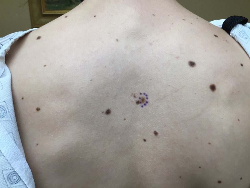 Dysplastic Nevi on patient's back