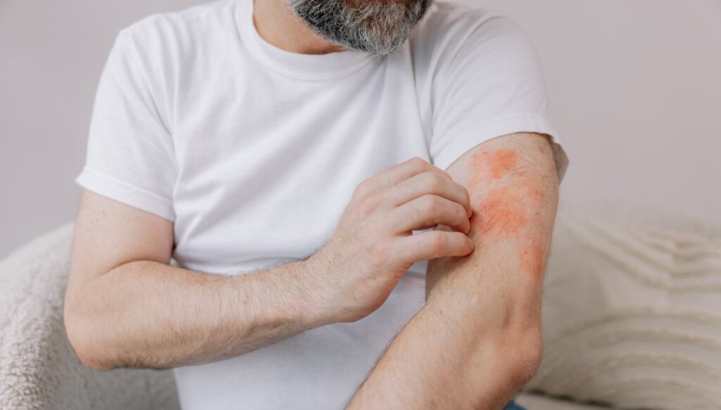 man itching his arm with eczema