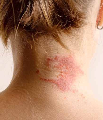 woman with ezcema on neck