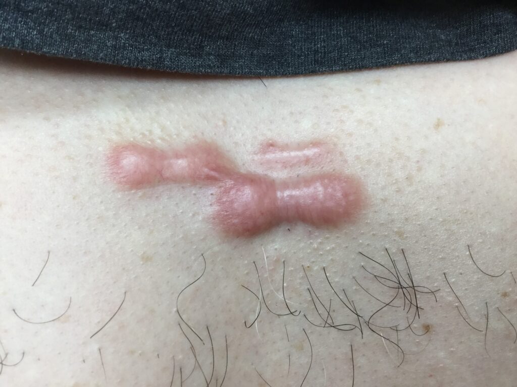 keloid scar