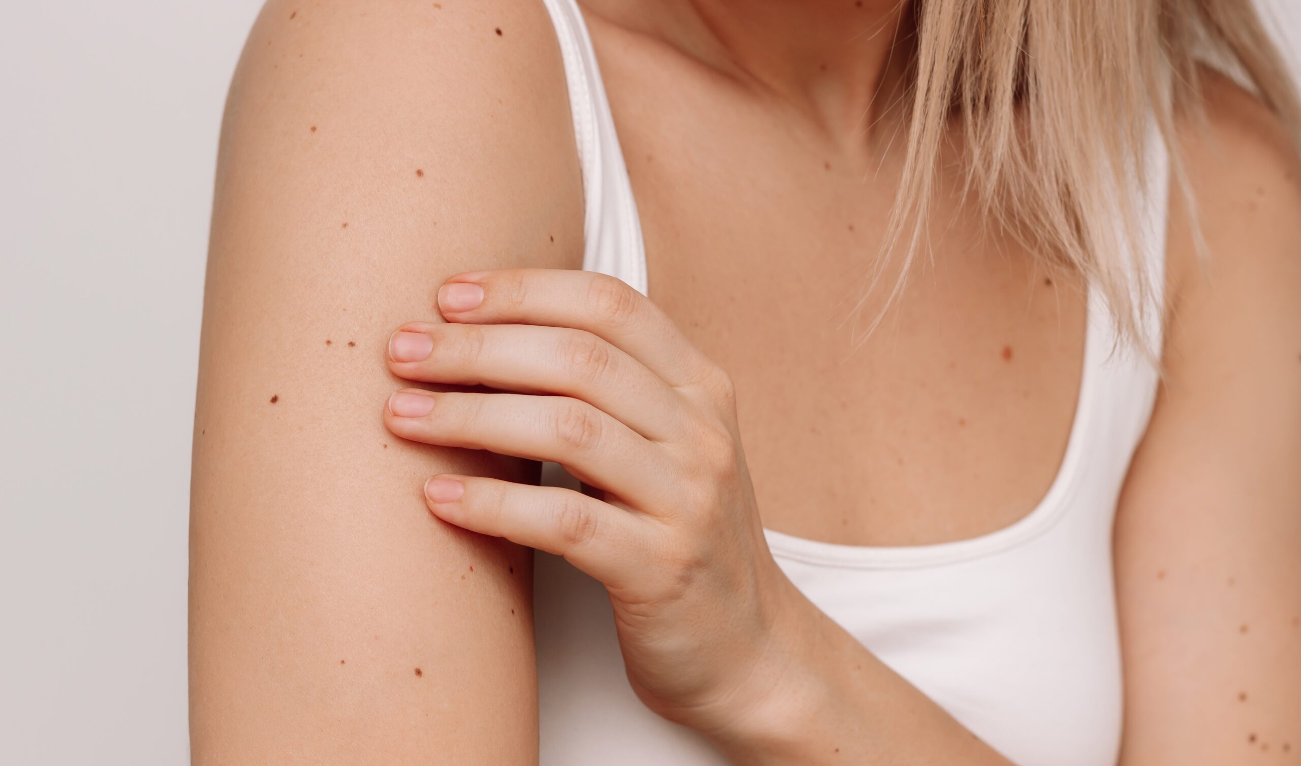 woman with moles on skin