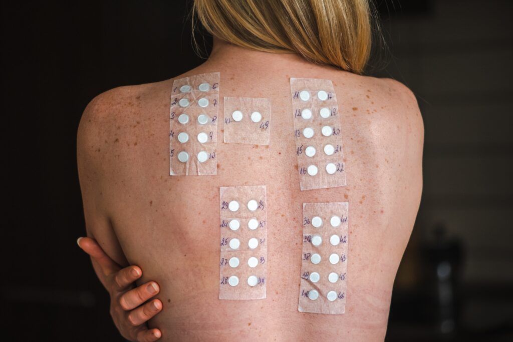 patch testing on patient's back