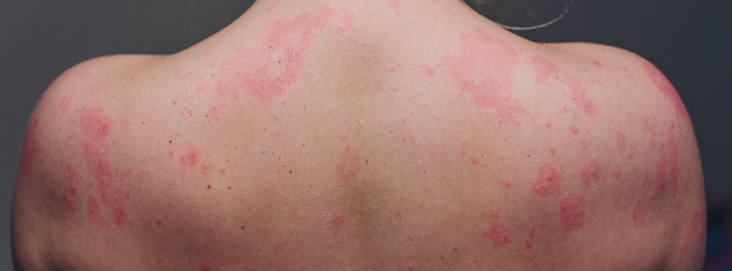 woman with rash on her back