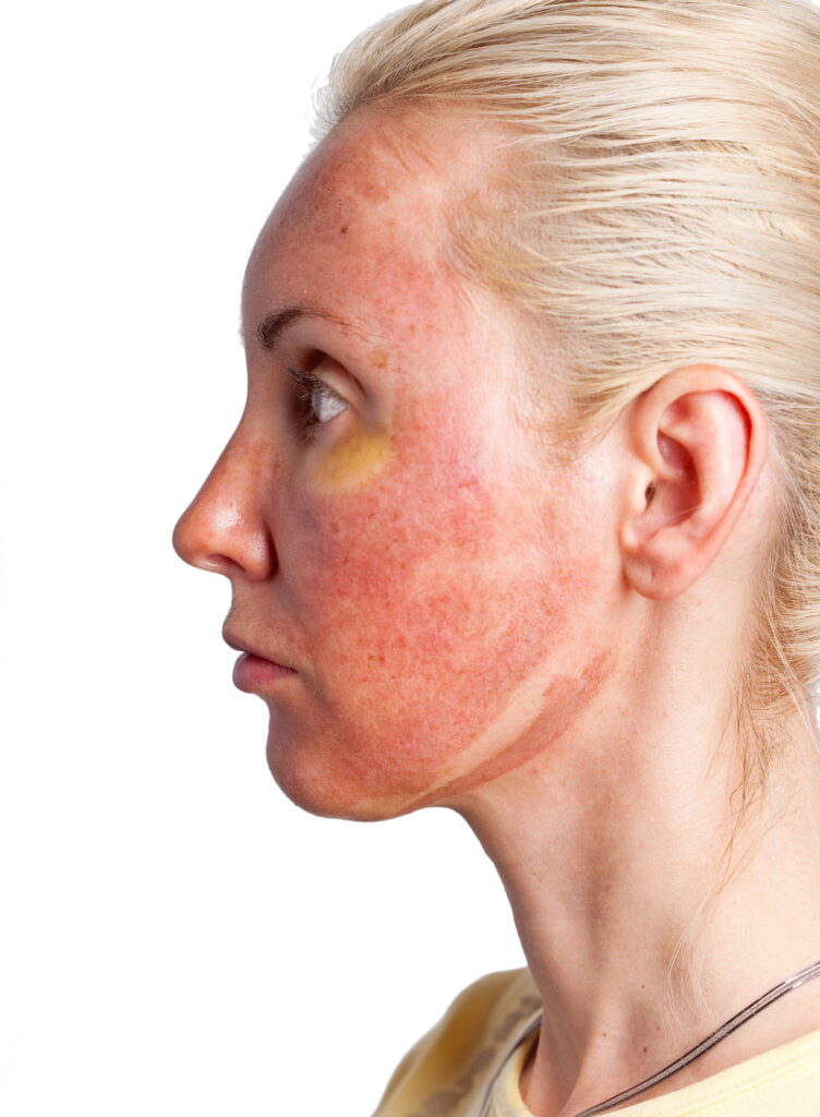Woman after chemical peel